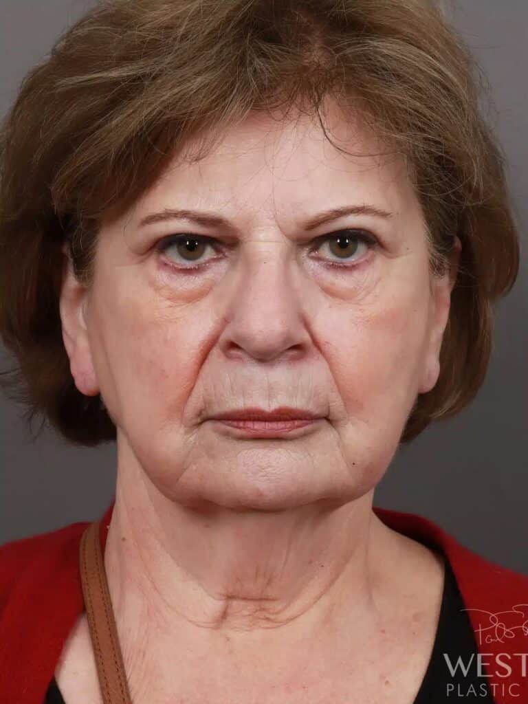 Before Image: Deep Plane Facelift & Neck Lift, Brow Lift, Eyelid Lift, Fat Grafting, and CO2 Resurfacing (5 Months Post-Op) - front