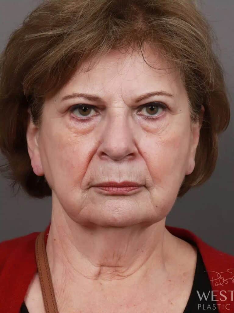 Before Image: Deep Plane Facelift & Neck Lift, Brow Lift, Eyelid Lift, Fat Grafting, and CO2 Resurfacing (5 Months Post-Op) - front
