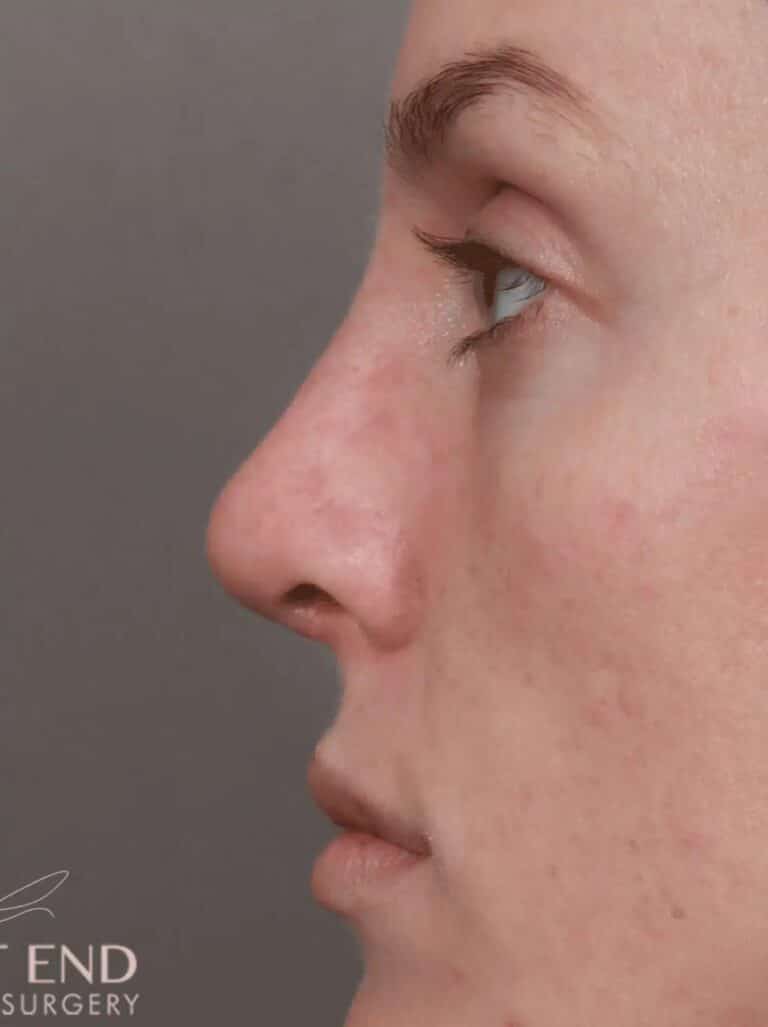 After Image: Rhinoplasty (2 Weeks Post-Op) - left-side