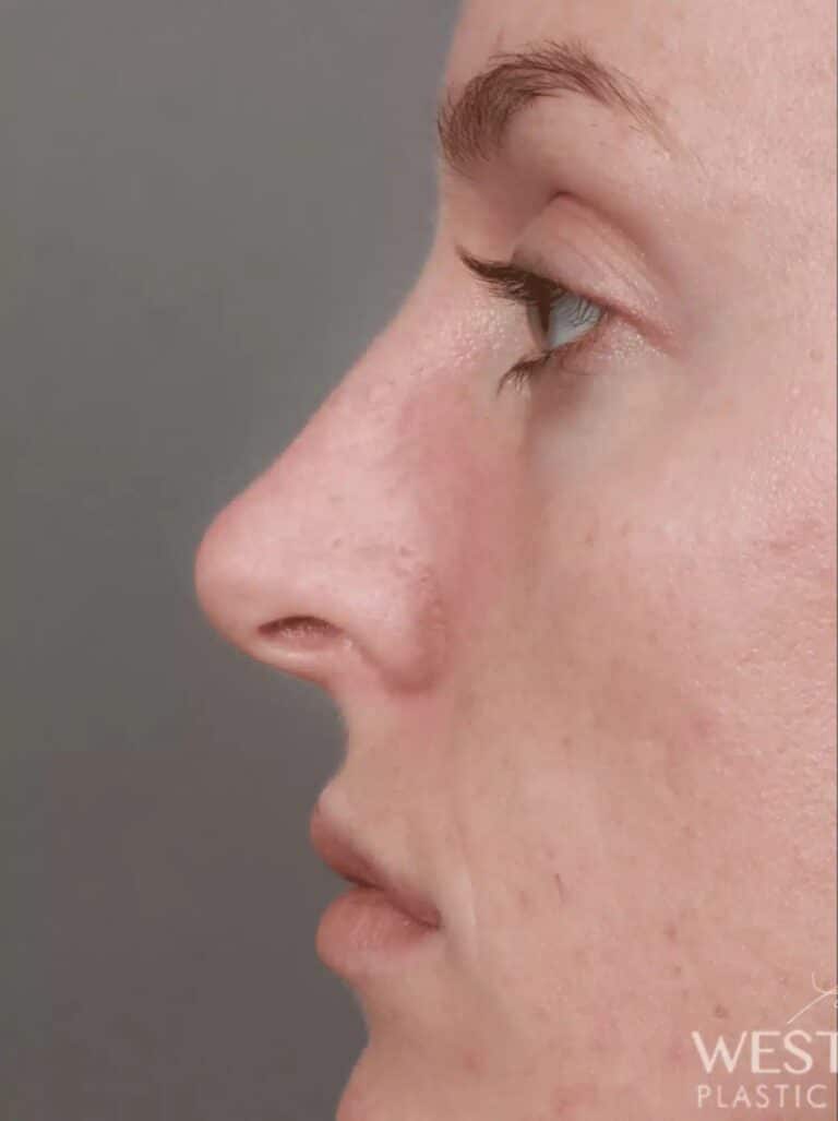 Before Image: Rhinoplasty (2 Weeks Post-Op) - left-side