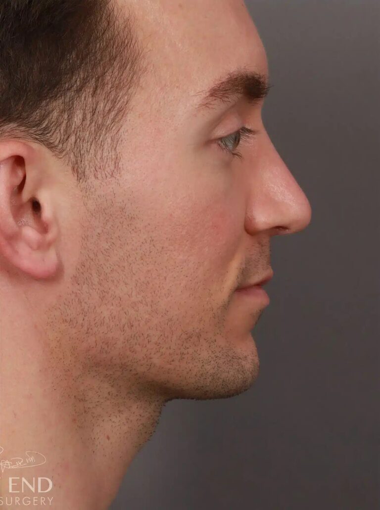 After Image: Structural Rhinoplasty (3 Months Post-Op) - right-side