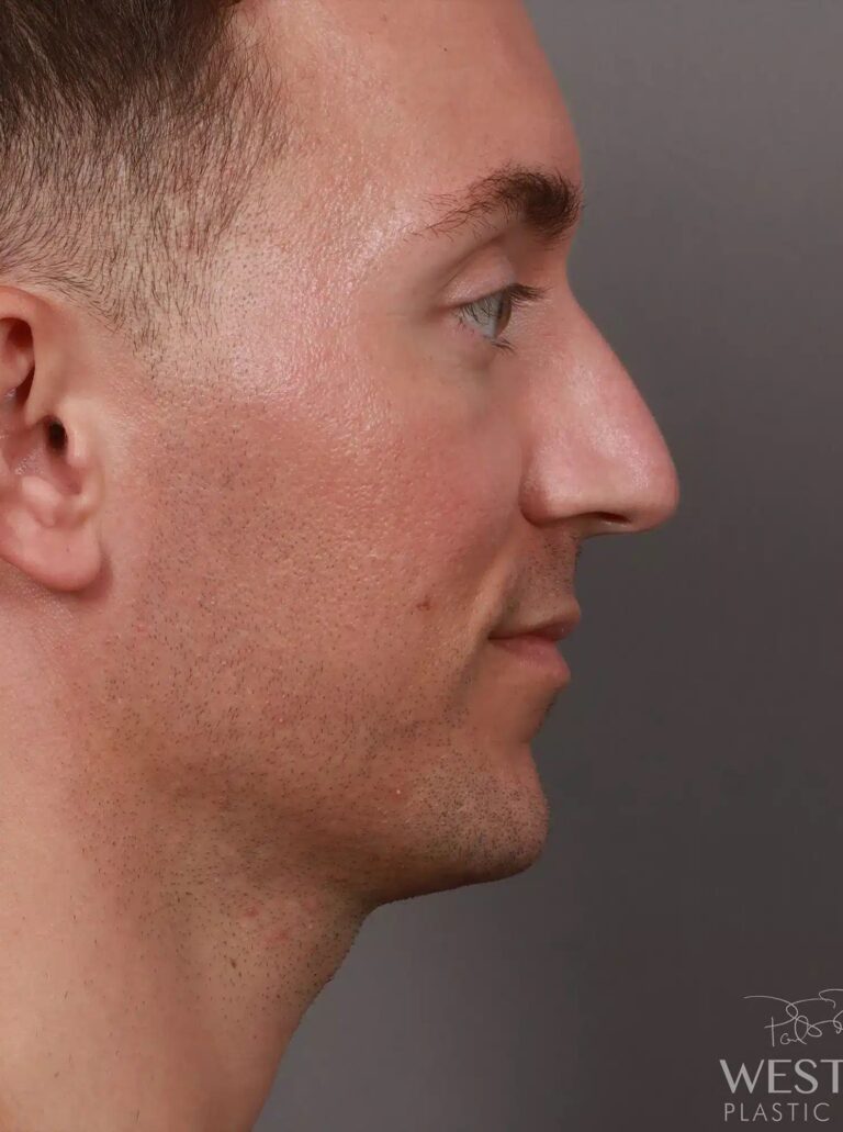 Before Image: Structural Rhinoplasty (3 Months Post-Op) - right-side