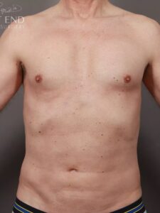 After Image: Pectoral Implants, Liposuction, & Renuvion Skin Tightening (2 months Post-Op)