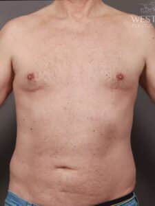 Before Image: Pectoral Implants, Liposuction, & Renuvion Skin Tightening (2 months Post-Op)