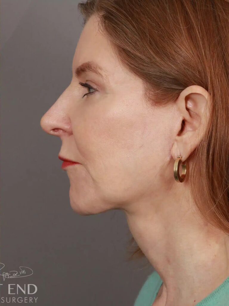 After Image: Deep Plane Facelift & Neck Lift, Brow Lift, Upper Eyelid Lift, Fat Grafting, and CO2 Resurfacing (5 Months Post-Op) - left-side