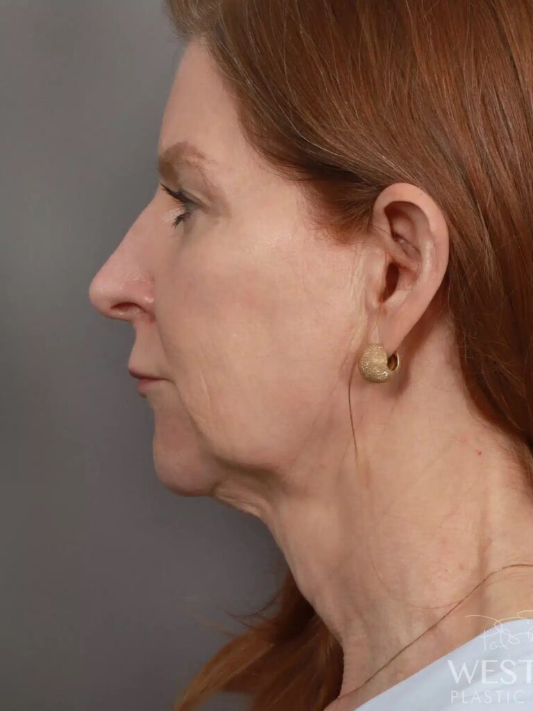 Before Image: Deep Plane Facelift & Neck Lift, Brow Lift, Upper Eyelid Lift, Fat Grafting, and CO2 Resurfacing (5 Months Post-Op) - left-side