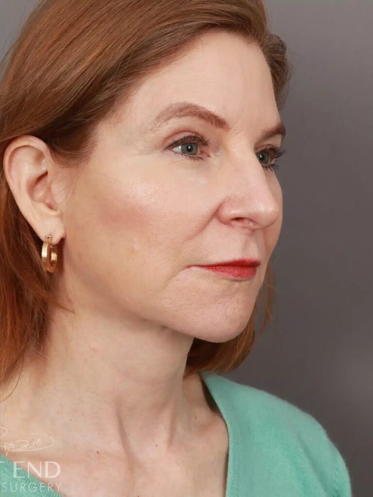 After Image: Deep Plane Facelift & Neck Lift, Brow Lift, Upper Eyelid Lift, Fat Grafting, and CO2 Resurfacing (5 Months Post-Op) - right-front-oblique