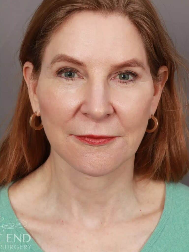 After Image: Deep Plane Facelift & Neck Lift, Brow Lift, Upper Eyelid Lift, Fat Grafting, and CO2 Resurfacing (5 Months Post-Op) - front