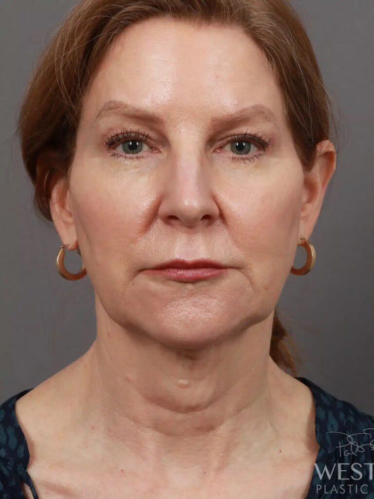 Before Image: Deep Plane Facelift & Neck Lift, Brow Lift, Upper Eyelid Lift, Fat Grafting, and CO2 Resurfacing (5 Months Post-Op) - front