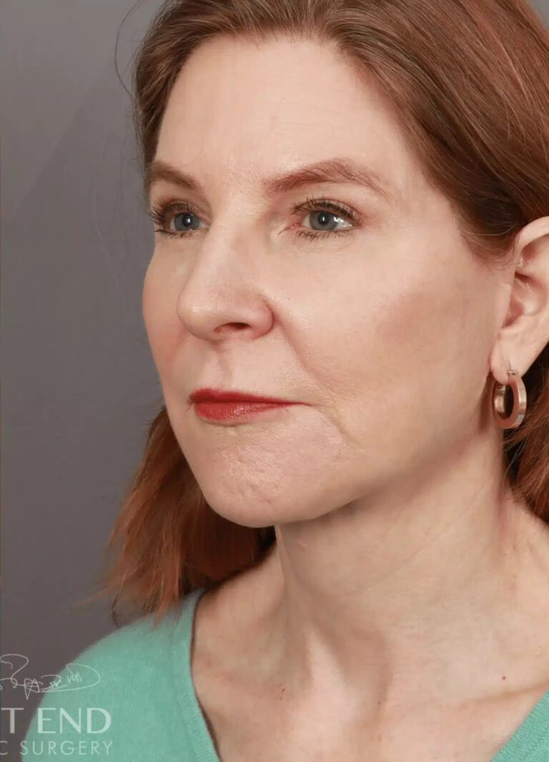 After Image: Deep Plane Facelift & Neck Lift, Brow Lift, Upper Eyelid Lift, Fat Grafting, and CO2 Resurfacing (5 Months Post-Op) - left-front-oblique