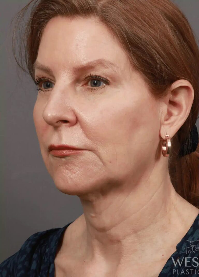Before Image: Deep Plane Facelift & Neck Lift, Brow Lift, Upper Eyelid Lift, Fat Grafting, and CO2 Resurfacing (5 Months Post-Op) - left-front-oblique