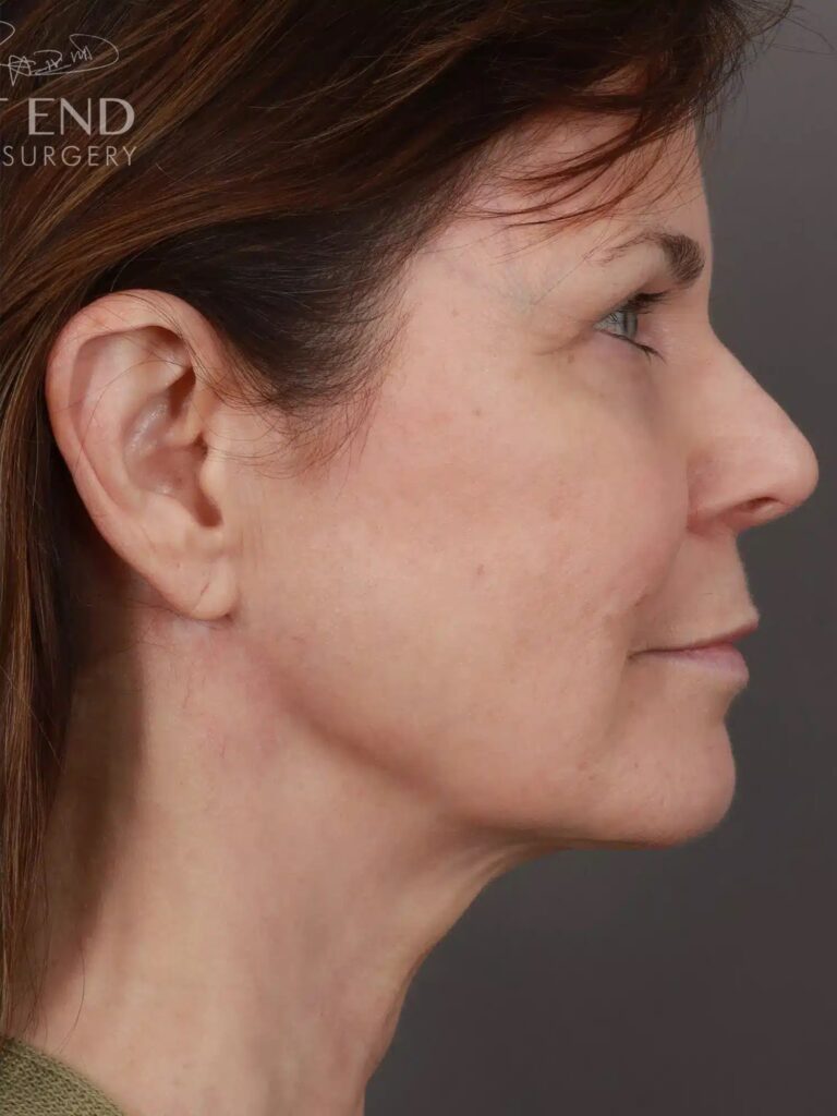After Image: Deep Plane Neck Lift (9 Months Post-Op) - right-side