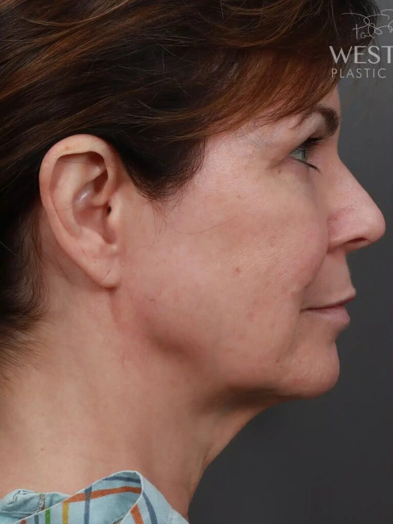 Before Image: Deep Plane Neck Lift (9 Months Post-Op) - right-side