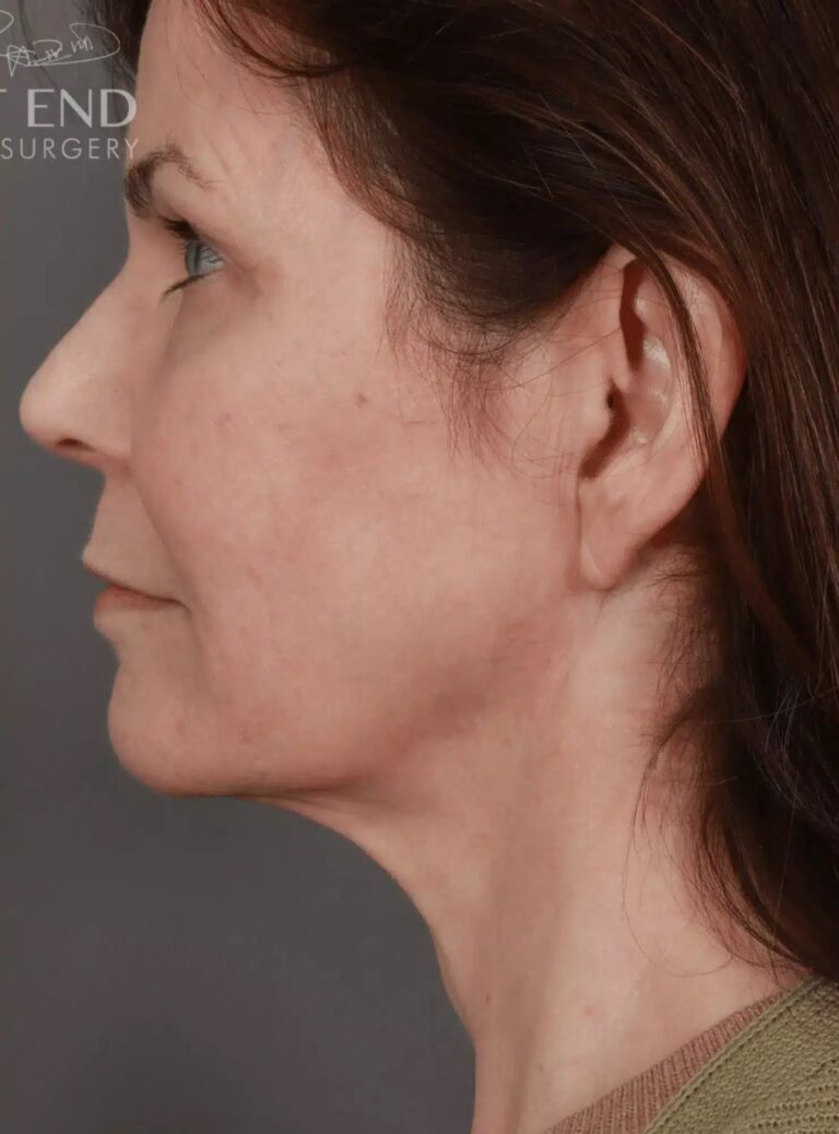 After Image: Deep Plane Neck Lift (9 Months Post-Op) - left-side