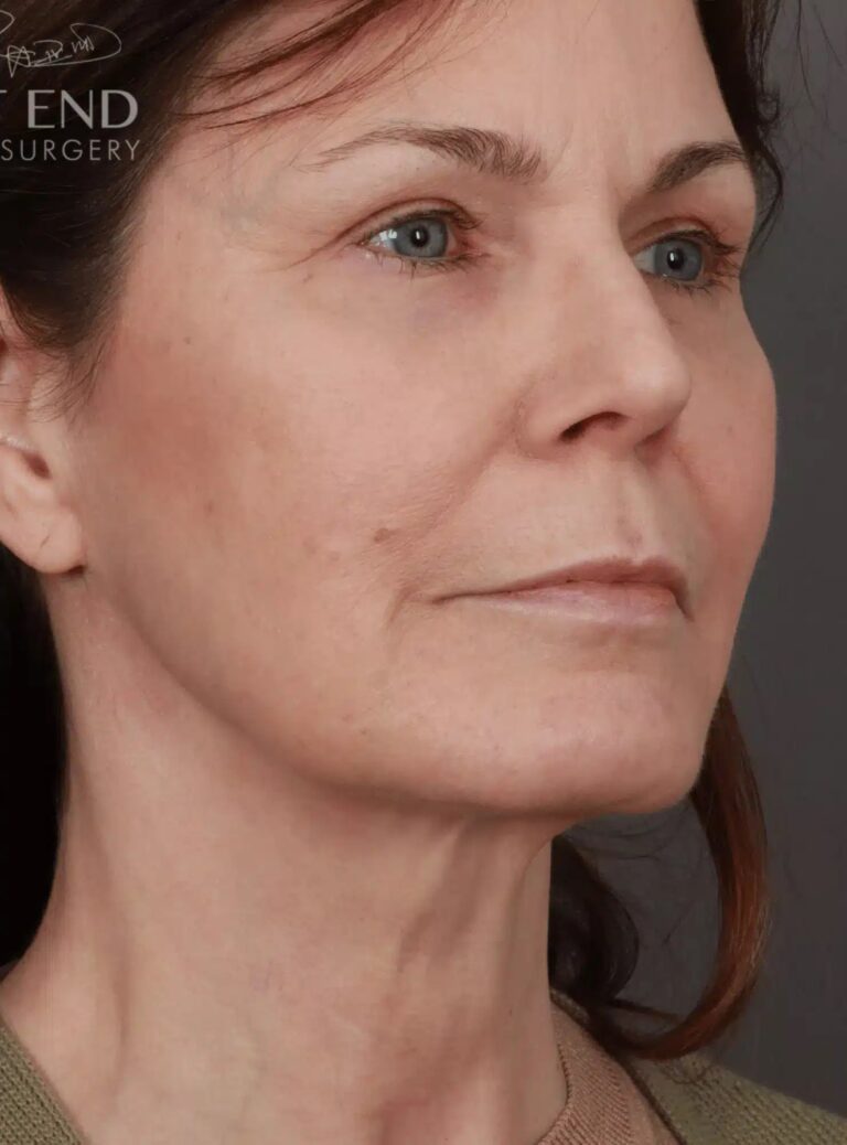 After Image: Deep Plane Neck Lift (9 Months Post-Op) - right-front-oblique