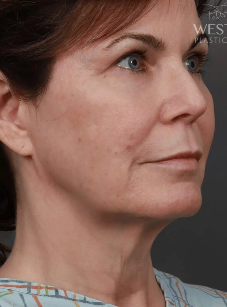 Before Image: Deep Plane Neck Lift (9 Months Post-Op) - right-front-oblique
