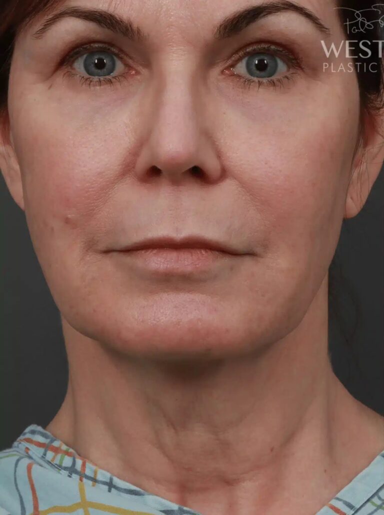 Before Image: Deep Plane Neck Lift (9 Months Post-Op) - front