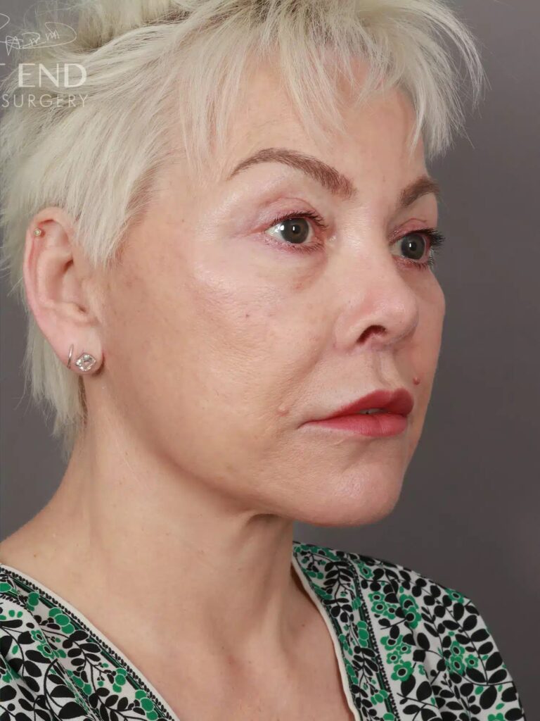 After Image: Deep Plane Facelift & Neck Lift, Eyelid Lift, Lip Lift, and Fat Grafting (9 Months Post-Op) - right-front-oblique