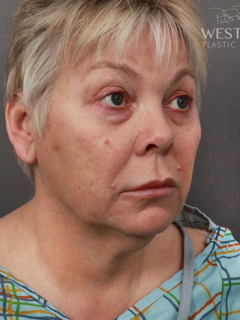 Before Image: Deep Plane Facelift & Neck Lift, Eyelid Lift, Lip Lift, and Fat Grafting (9 Months Post-Op) - right-front-oblique