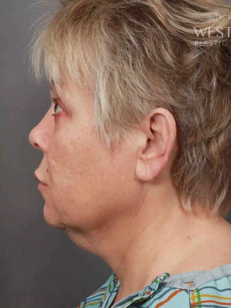 Before Image: Deep Plane Facelift & Neck Lift, Eyelid Lift, Lip Lift, and Fat Grafting (9 Months Post-Op) - left-side