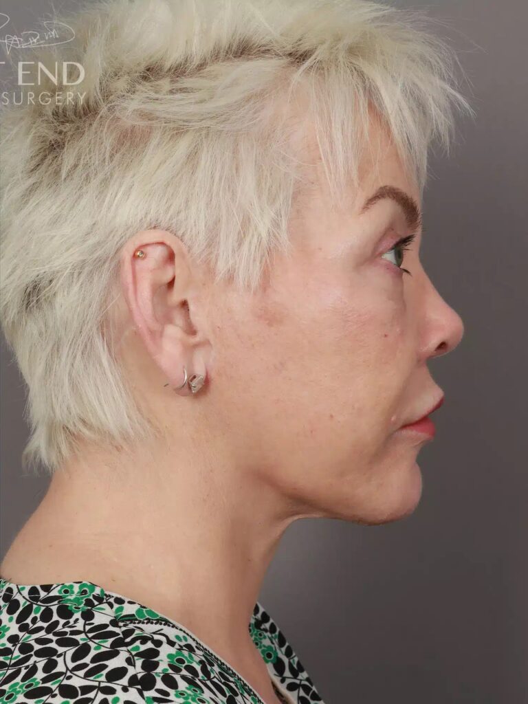After Image: Deep Plane Facelift & Neck Lift, Eyelid Lift, Lip Lift, and Fat Grafting (9 Months Post-Op) - right-side