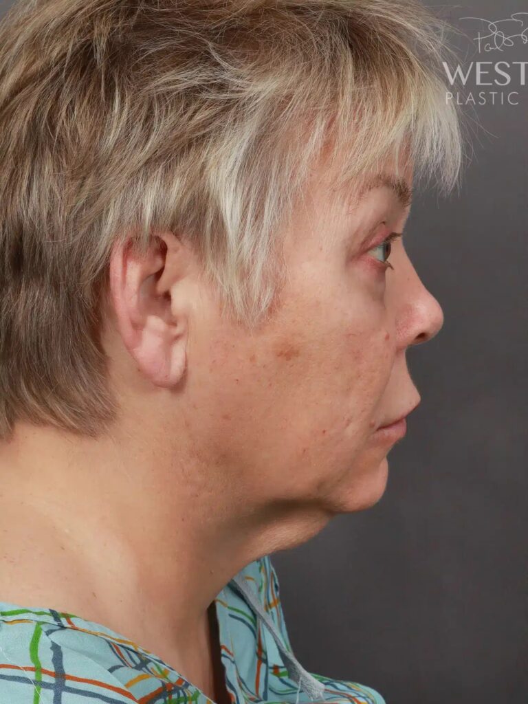 Before Image: Deep Plane Facelift & Neck Lift, Eyelid Lift, Lip Lift, and Fat Grafting (9 Months Post-Op) - right-side