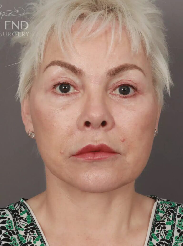 After Image: Deep Plane Facelift & Neck Lift, Eyelid Lift, Lip Lift, and Fat Grafting (9 Months Post-Op) - front