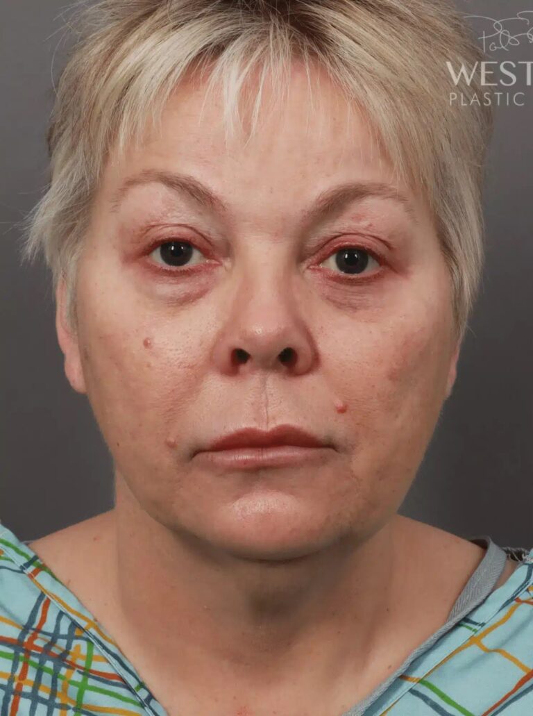 Before Image: Deep Plane Facelift & Neck Lift, Eyelid Lift, Lip Lift, and Fat Grafting (9 Months Post-Op) - front