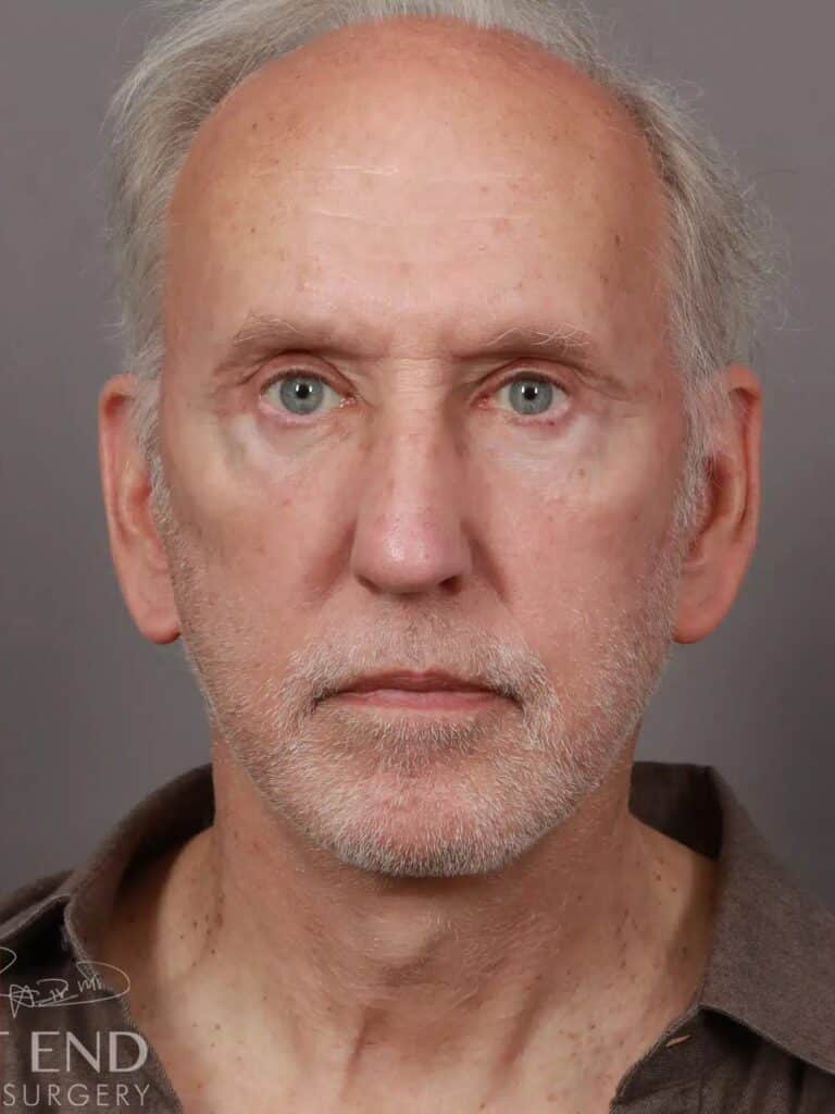 After Image: Deep Plane Facelift & Neck Lift, Eyelid Lift, Fat Grafting, and CO2 Resurfacing (5 Months Post-Op) - front