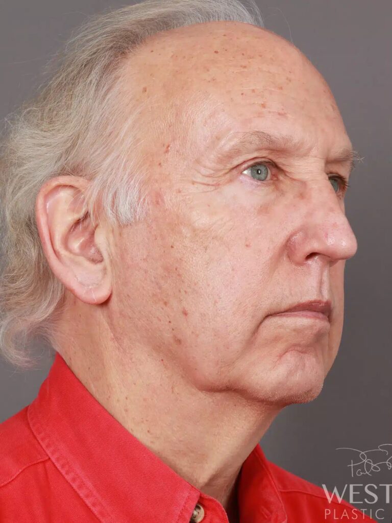 Before Image: Deep Plane Facelift & Neck Lift, Eyelid Lift, Fat Grafting, and CO2 Resurfacing (5 Months Post-Op) - right-front-oblique