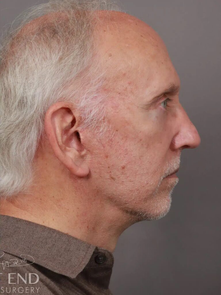 After Image: Deep Plane Facelift & Neck Lift, Eyelid Lift, Fat Grafting, and CO2 Resurfacing (5 Months Post-Op) - right-side
