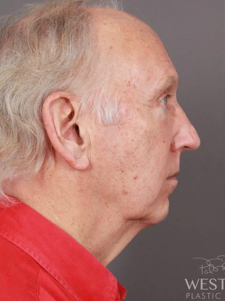Before Image: Deep Plane Facelift & Neck Lift, Eyelid Lift, Fat Grafting, and CO2 Resurfacing (5 Months Post-Op) - right-side