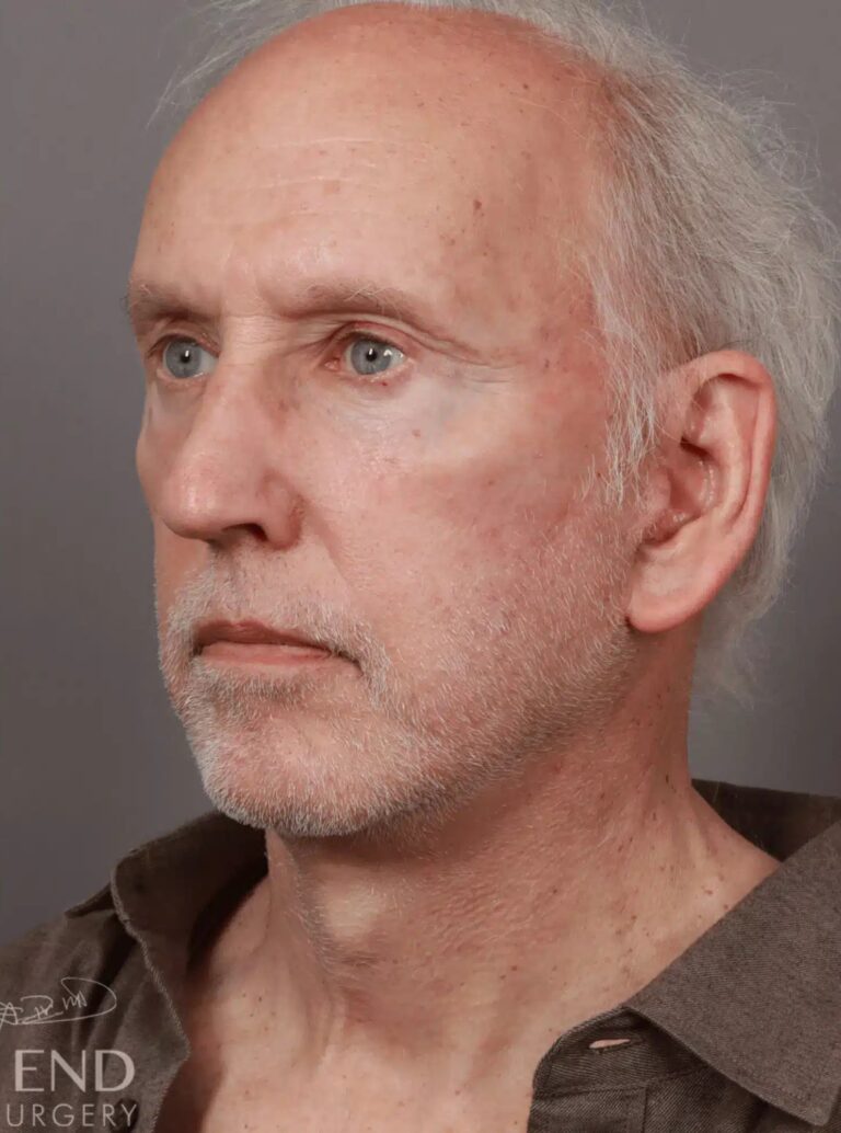 After Image: Deep Plane Facelift & Neck Lift, Eyelid Lift, Fat Grafting, and CO2 Resurfacing (5 Months Post-Op) - left-front-oblique