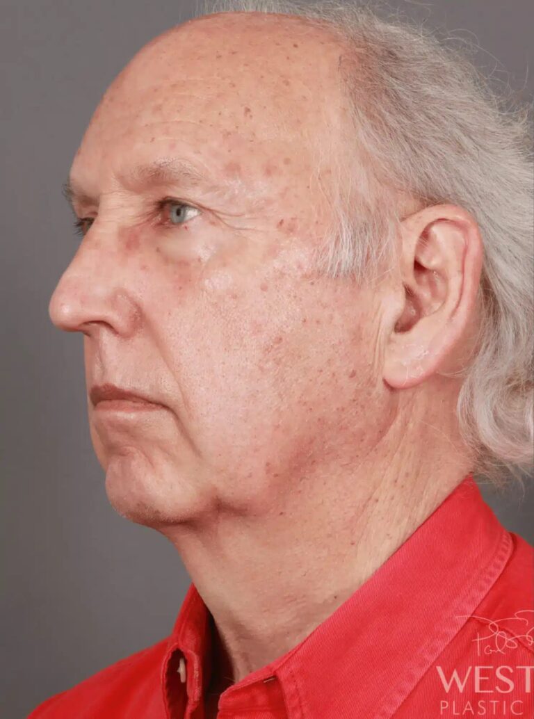 Before Image: Deep Plane Facelift & Neck Lift, Eyelid Lift, Fat Grafting, and CO2 Resurfacing (5 Months Post-Op) - left-front-oblique