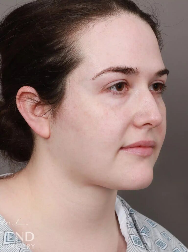 After Image: Liposuction of the Submental, Jawline, and Neck Region (3.5 Months Post-Op) - right-front-oblique