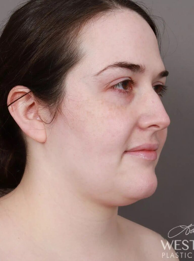 Before Image: Liposuction of the Submental, Jawline, and Neck Region (3.5 Months Post-Op) - right-front-oblique