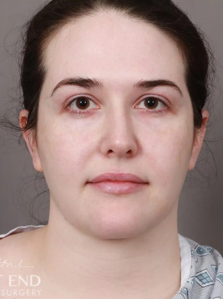 After Image: Liposuction of the Submental, Jawline, and Neck Region (3.5 Months Post-Op) - front