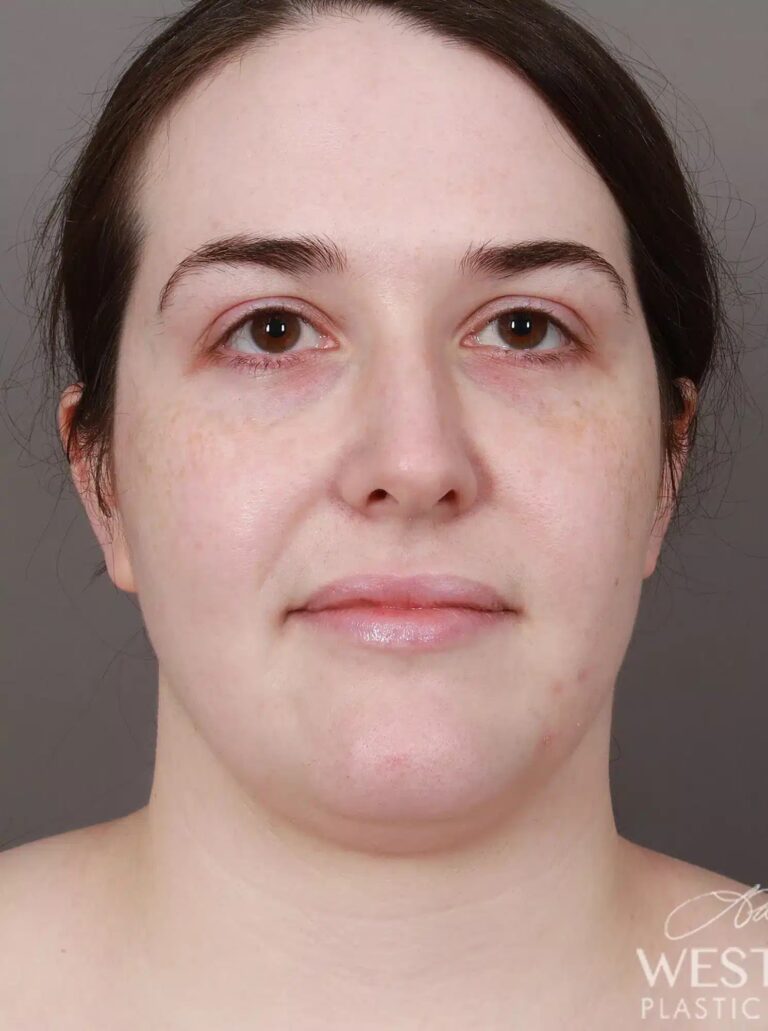 Before Image: Liposuction of the Submental, Jawline, and Neck Region (3.5 Months Post-Op) - front