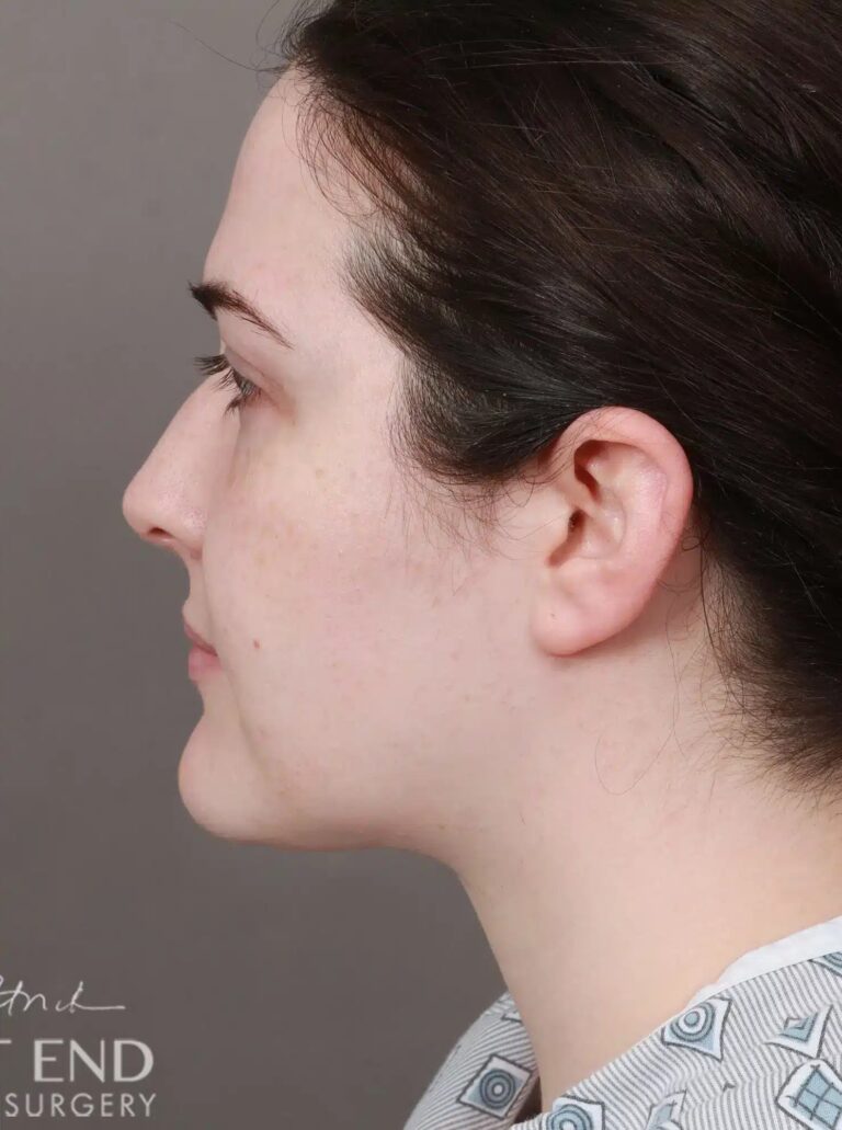 After Image: Liposuction of the Submental, Jawline, and Neck Region (3.5 Months Post-Op) - left-side
