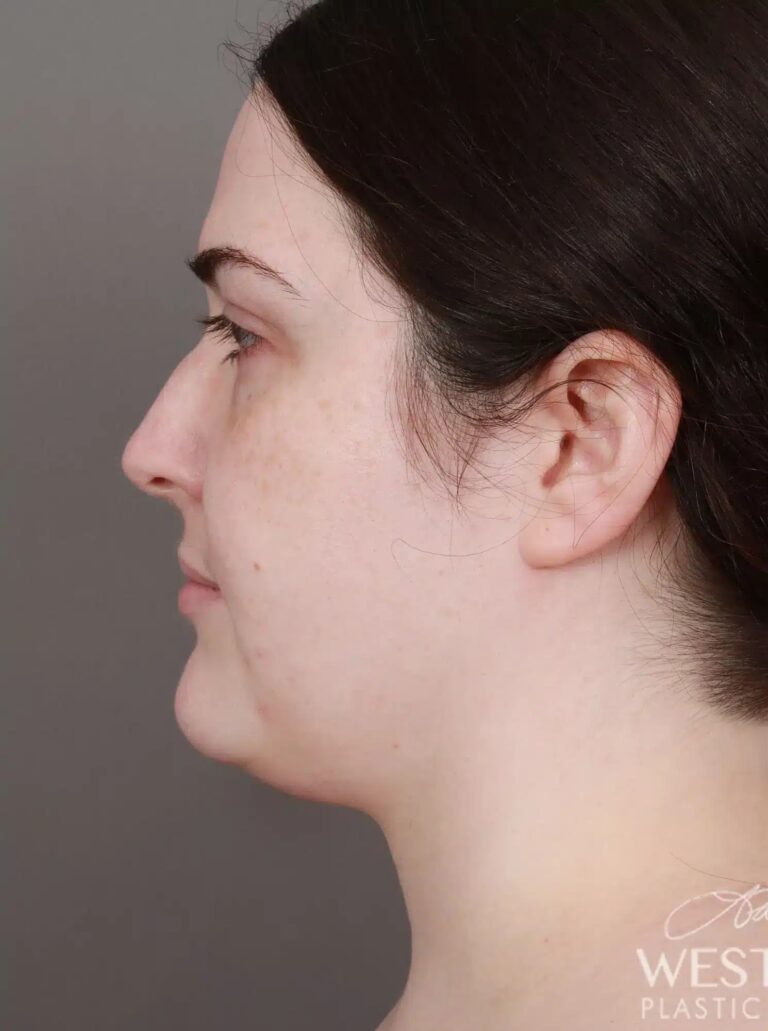 Before Image: Liposuction of the Submental, Jawline, and Neck Region (3.5 Months Post-Op) - left-side