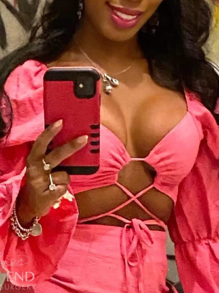 After Image: Breast Augmentation - front