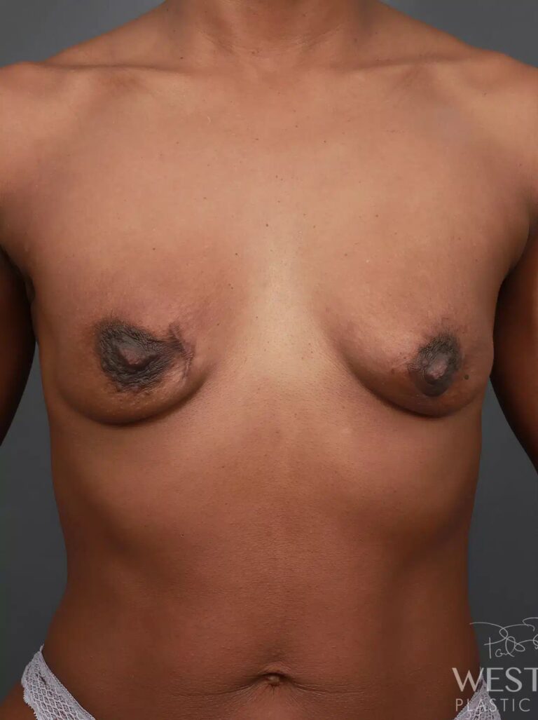 Before Image: Breast Augmentation - front