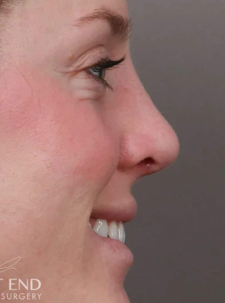 After Image: Rhinoplasty (1 Month Post-Op) - right-side