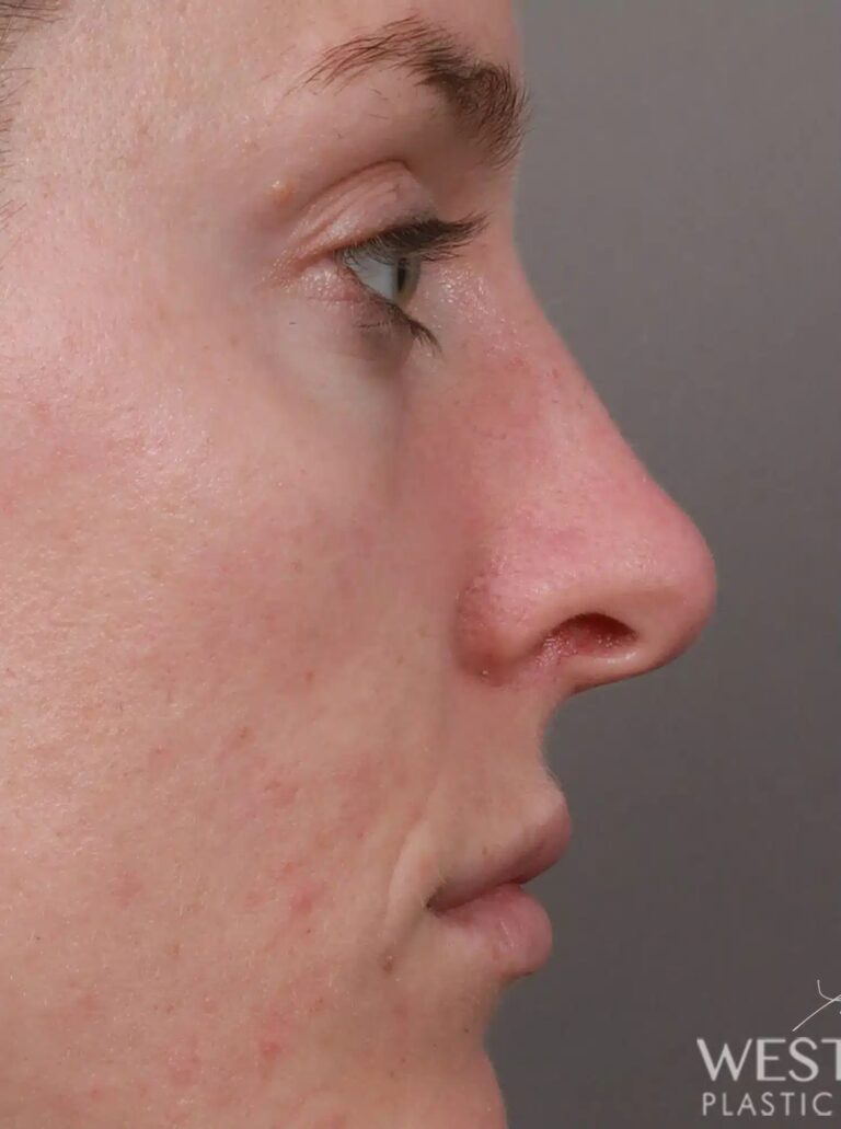 Before Image: Rhinoplasty (1 Month Post-Op) - right-side