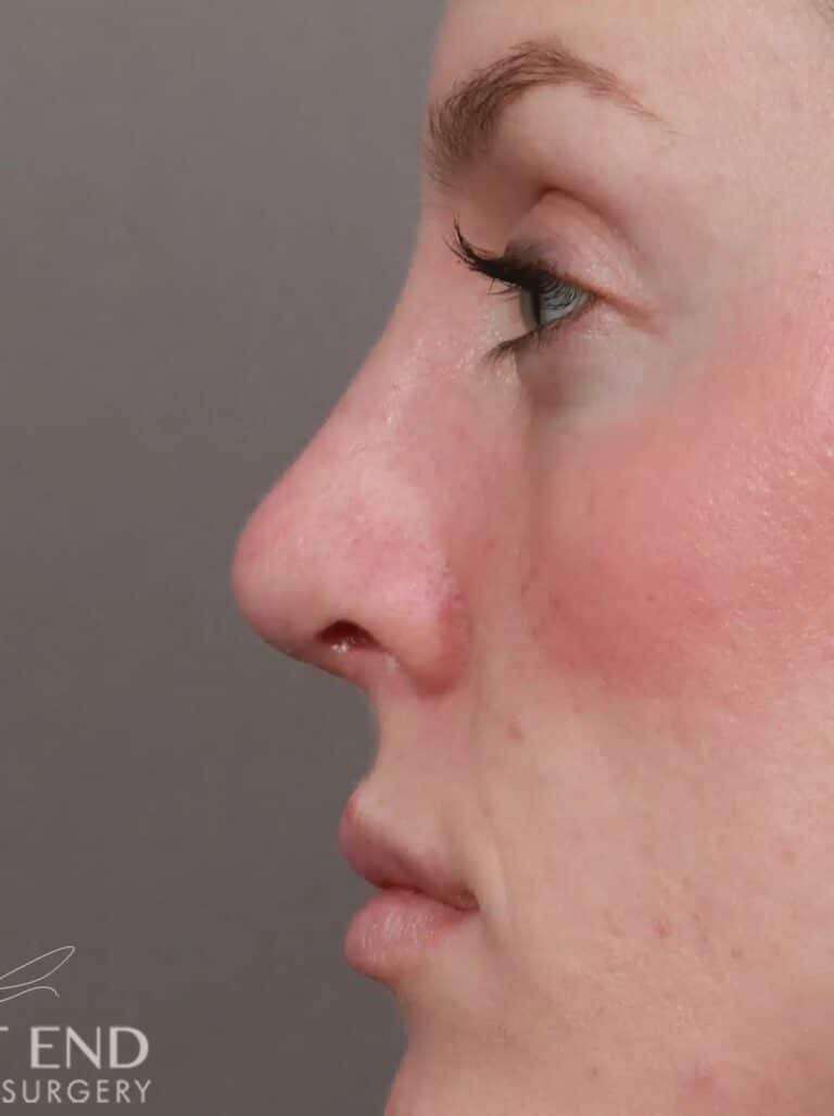 After Image: Rhinoplasty (1 Month Post-Op) - left-side