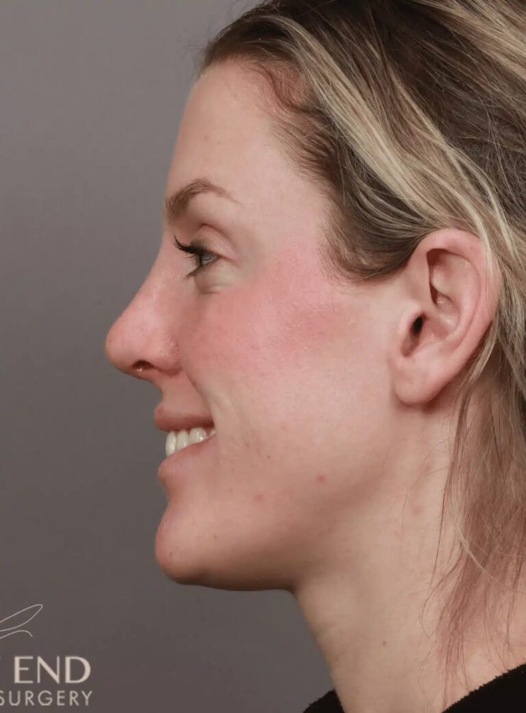 After Image: Rhinoplasty (1 Month Post-Op) - left-side