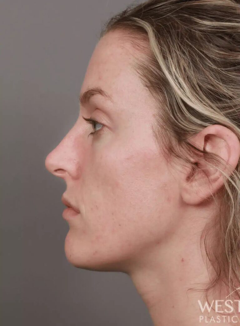 Before Image: Rhinoplasty (1 Month Post-Op) - left-side