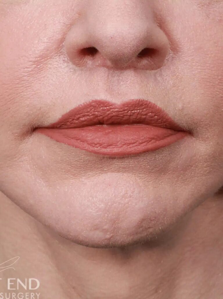 After Image: Lip Lift (1.5 Months Post-Op) - front