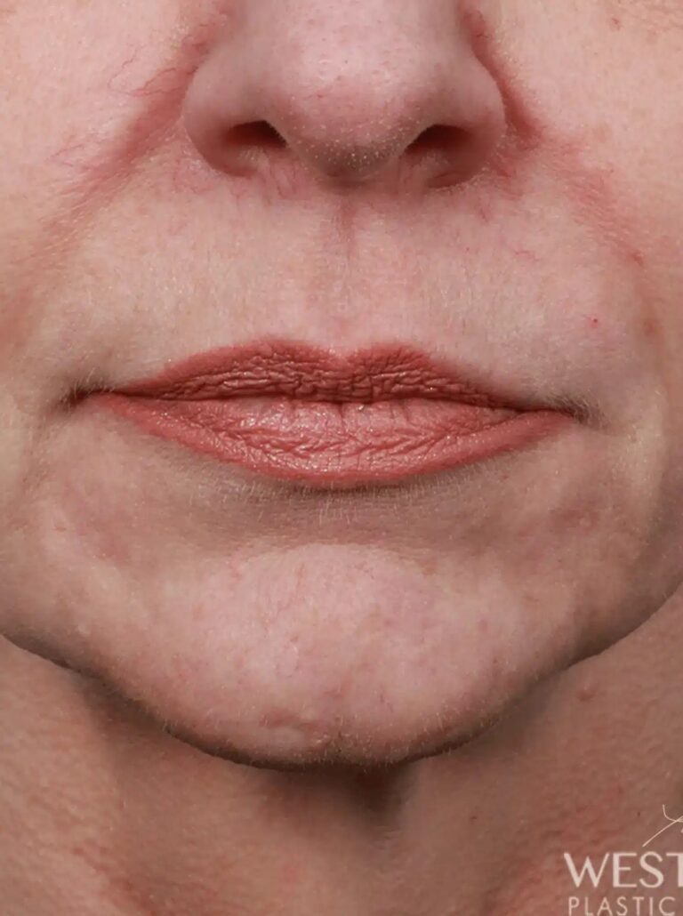 Before Image: Lip Lift (1.5 Months Post-Op) - front