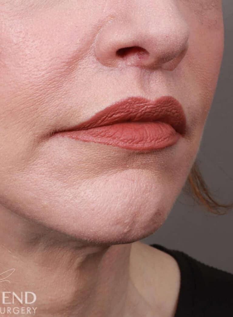 After Image: Lip Lift (1.5 Months Post-Op) - right-front-oblique